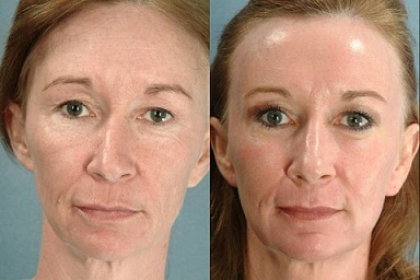 Лазерный пилинг лица - фото до и после