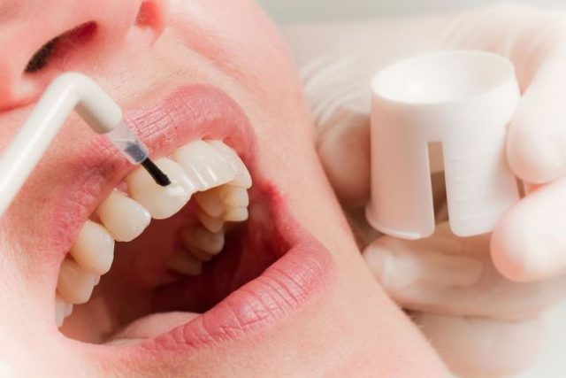 Покрытие зубов гелем с фтором