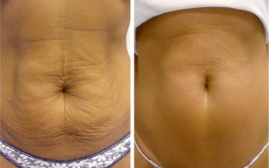 Результаты щипкового массажа живота - фото до и после