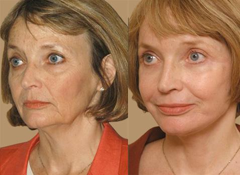 Химический пилинг лица - фото до и после