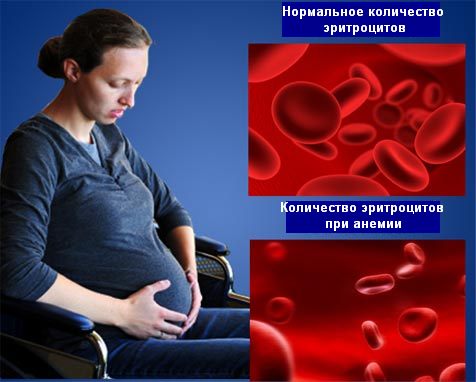 Причины, степени железодефицитной анемии при беременности