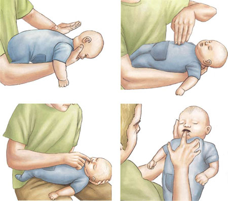 Ребенок подавился, задыхается – первая помощь грудничку