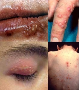 Герпевирусная инфекция - её опасность и симптомы