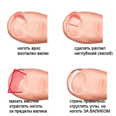 Народные рецепты лечения вросшего ногтя