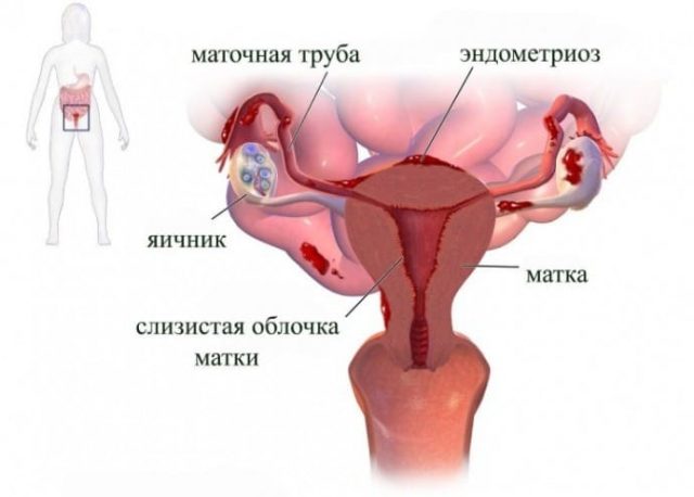 Эндометриоз при беременности - риски и шансы