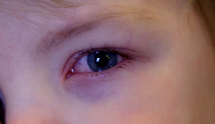 Красные глаза у ребенка - причины