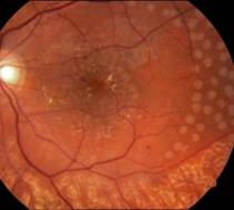Лечение диабетической ретинопатии