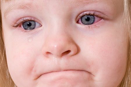 Красные глаза у ребенка - когда обращаться к врачу