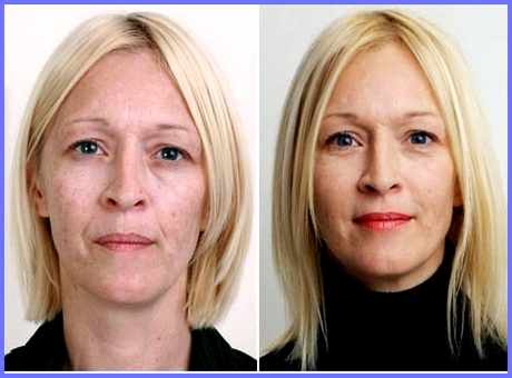 Лицо после алмазного пилинга - фото до и после
