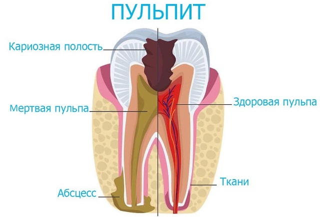 Пульпит зуба лечение