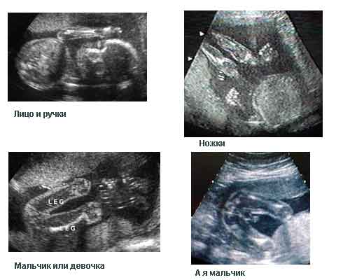 УЗИ -22 неделя беременности
